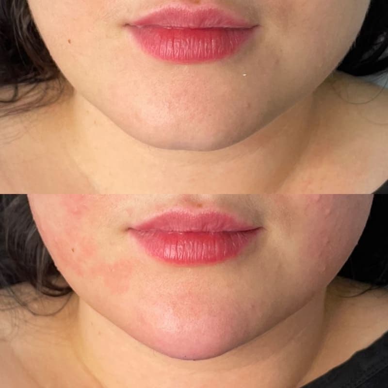 Chin filler no logo 2