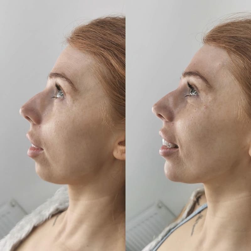 Chin filler no logo 3