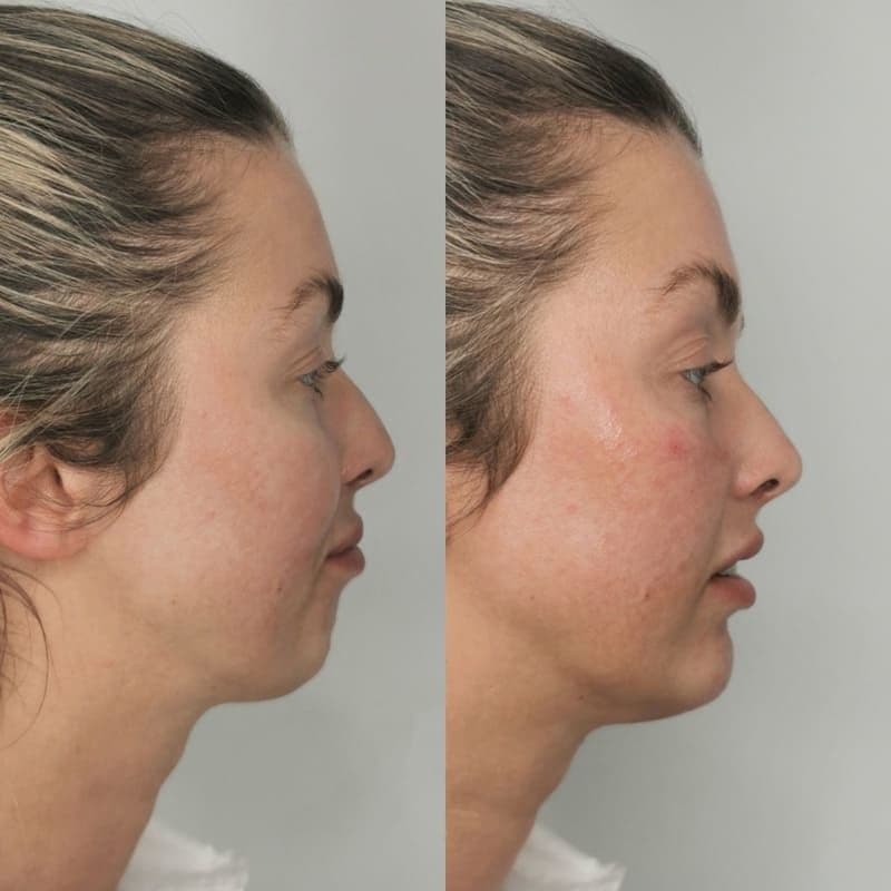 Chin filler no logo_