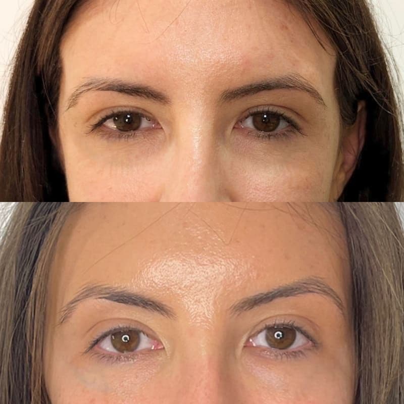 Eyebrow lift no logo