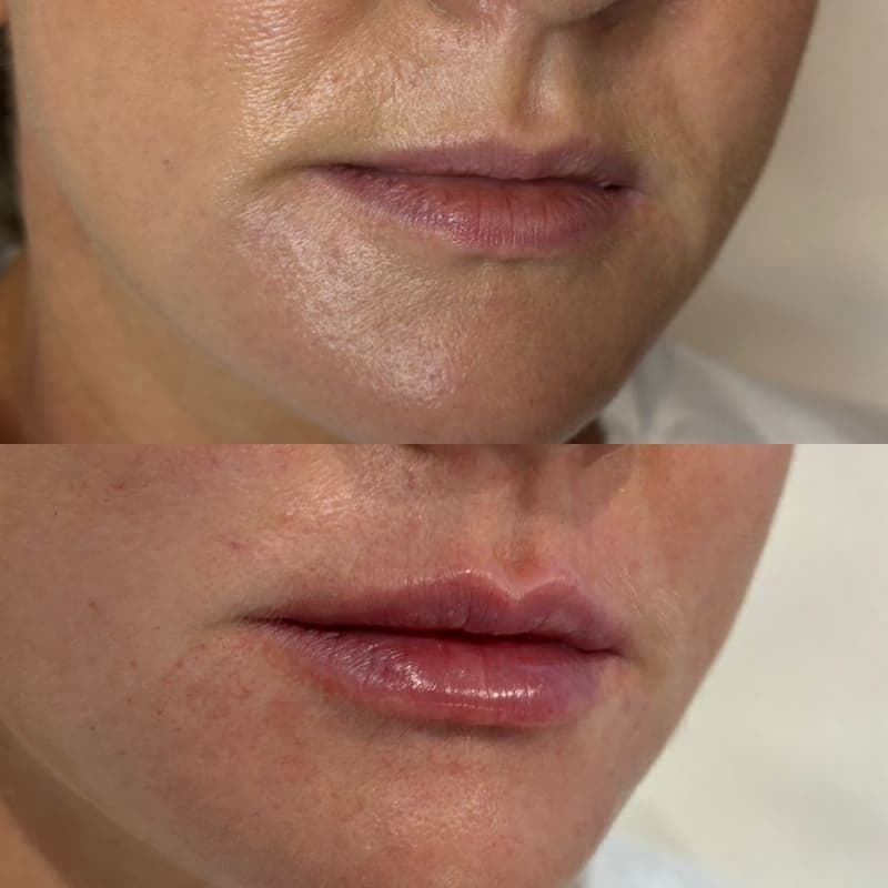 lip filler 2