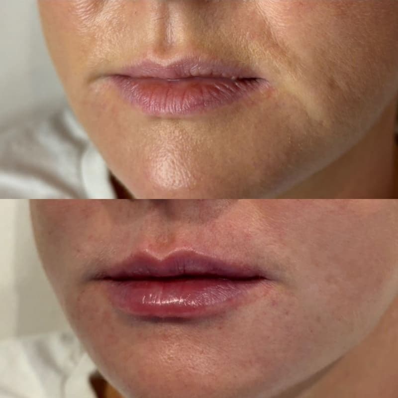 lip filler 3