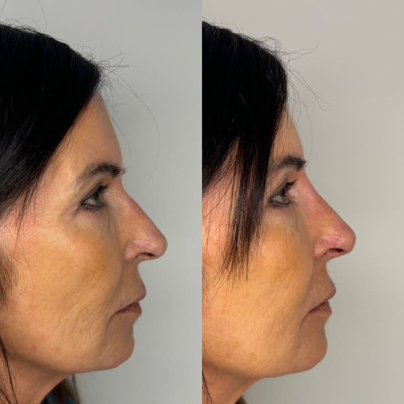 non-surgical rhinoplasty